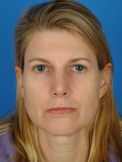 revision rhinoplasty 7395 post op