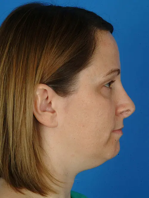 Revision Rhinoplasty 7396 Profile View Pre Op