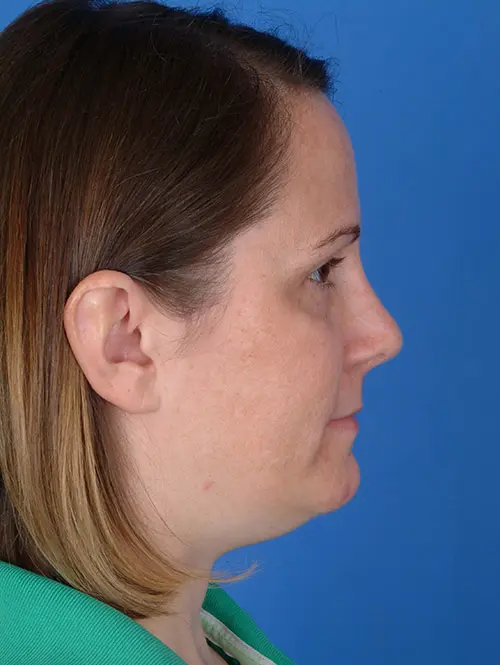 Revision Rhinoplasty 7396 Profile View 6 months Post Op
