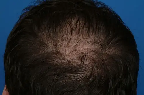 After: 7 mos post-op Micrograft Transplant 2918 Hair Restoration Treatment