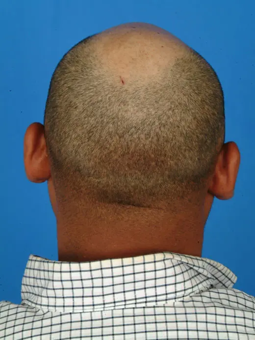 Before: Otoplasty Ear Pinning 2919