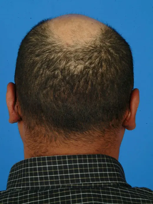 After: Otoplasty Ear Pinning 2919