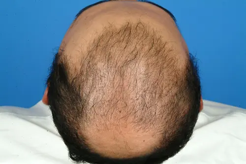 29-yr-old-male-travels-to-Houston-for-Hair-Restoration | After Hair Restoration Surgery