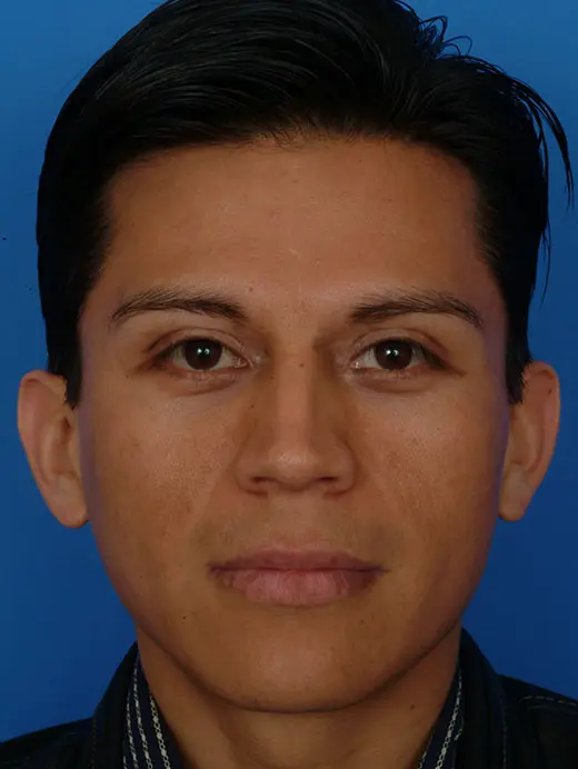 Ear Surgery (Otoplasty) Cheek Implants, Ear Pinning Surgery 2922 Front View Pre Op