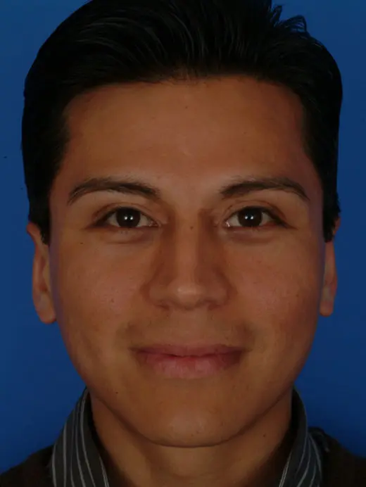 Ear Surgery (Otoplasty) Cheek Implants, Ear Pinning Surgery 2922 Front View 3 month Post-op