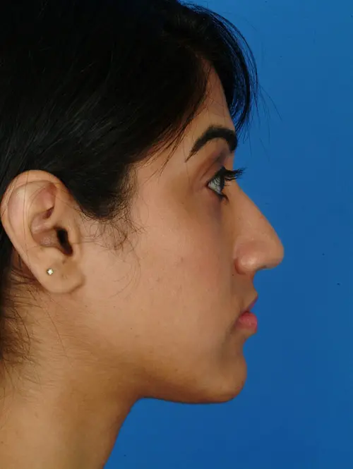 Ethnic Rhinoplasty 2925 Profile Before