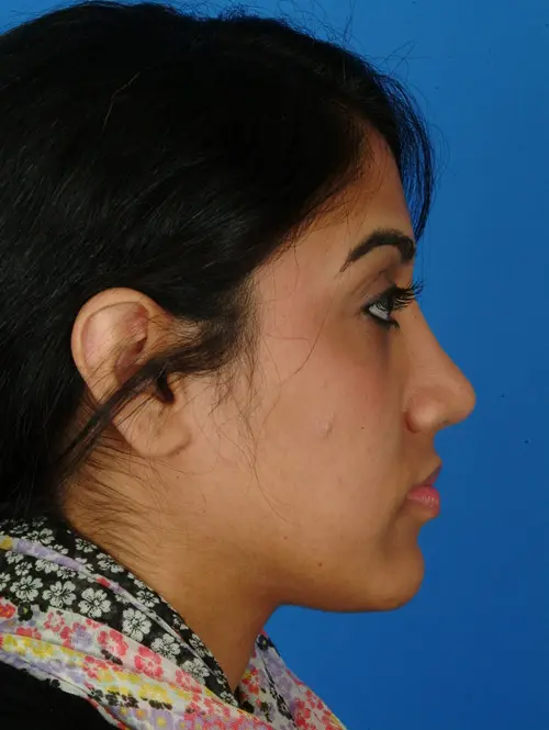 Ethnic Rhinoplasty 2925 Profile 6 Months After