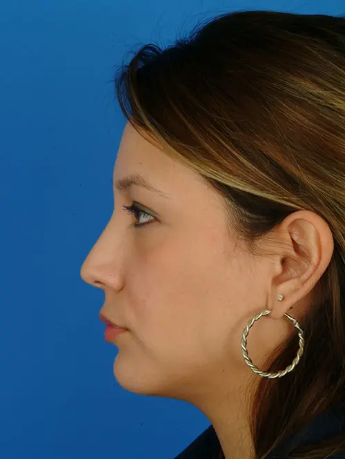 Rhinoplasty Case 2941 Profile After