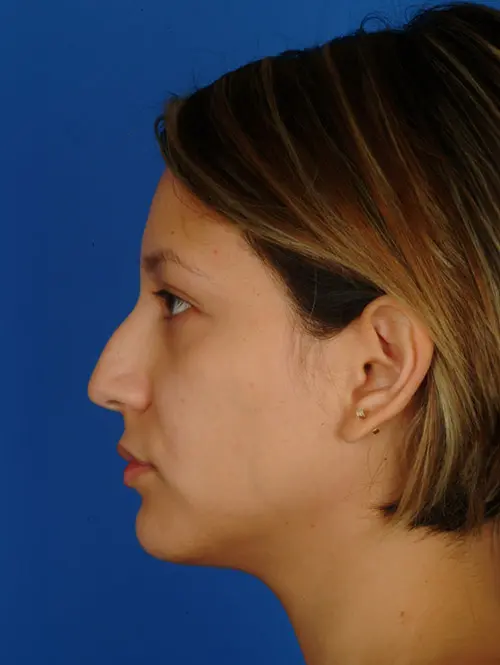 Rhinoplasty Case 2941 Profile Before