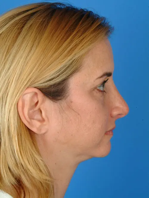 Deviated Septum Rhinoplasty 2943 Profile View 4 Months Post Op