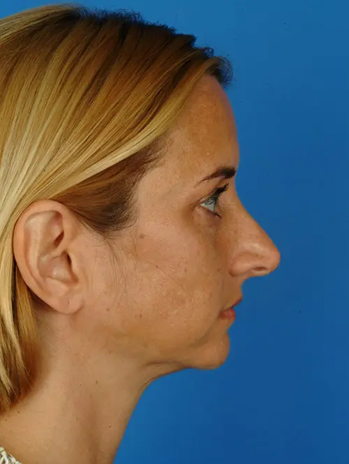 Deviated Septum Rhinoplasty 2943 Profile View Before