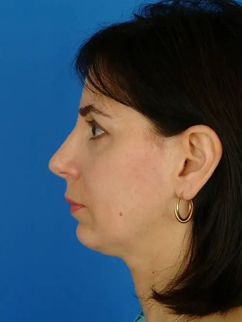 Rhinoplasty 2945 Profile After