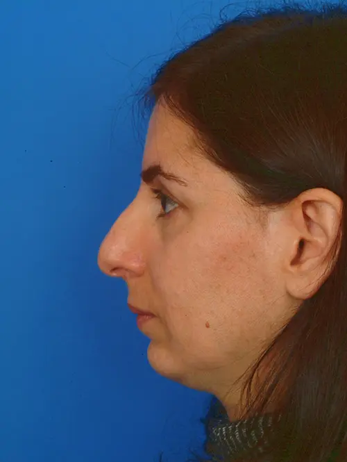 Rhinoplasty 2945 Profile Before