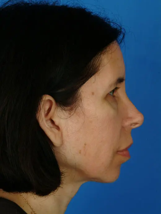 Brow Lift 2948 Profile View Pre Op