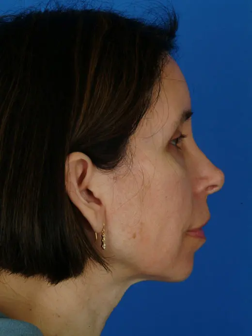 Brow Lift 2948 Profile View 5 mo Post-Op Browlift