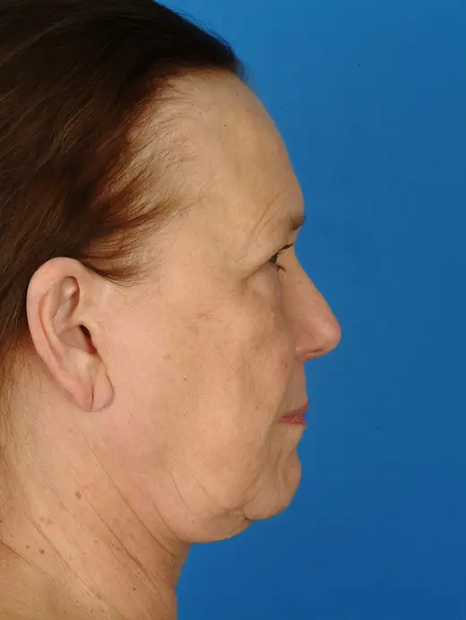 Facelift,browlift, eyelid surgery. 2951 profile view pre op