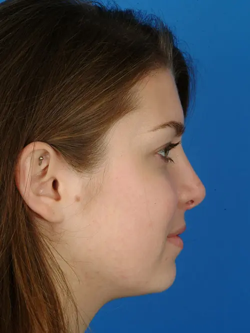 2952 Rhinoplasty Profile After