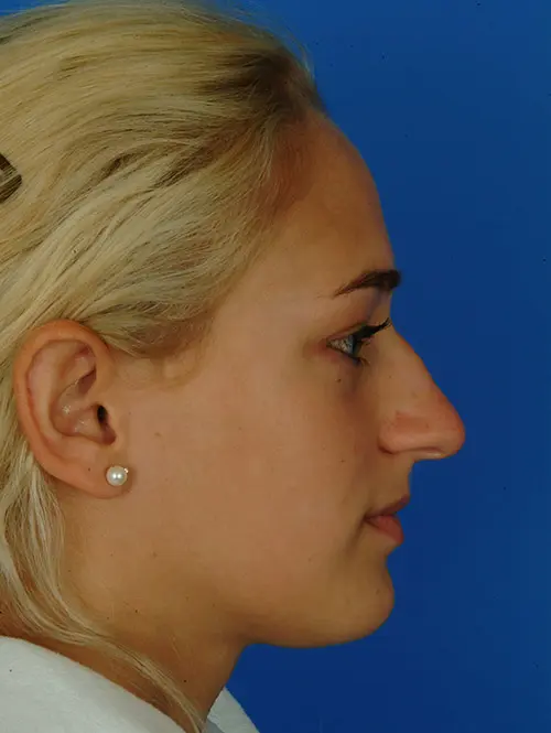 Rhinoplasty-Photos-After-Nasal-Fracture-Correction | Before Ethnic Rhinoplasty