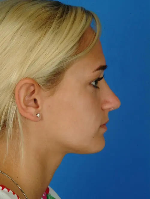 Rhinoplasty-Photos-After-Nasal-Fracture-Correction | After Ethnic Rhinoplasty