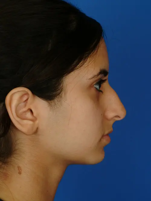 Ethnic rhinoplasty 2957 Before Profile View