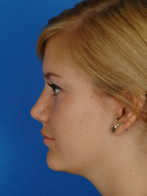2961 Rhinoplasty Profile After