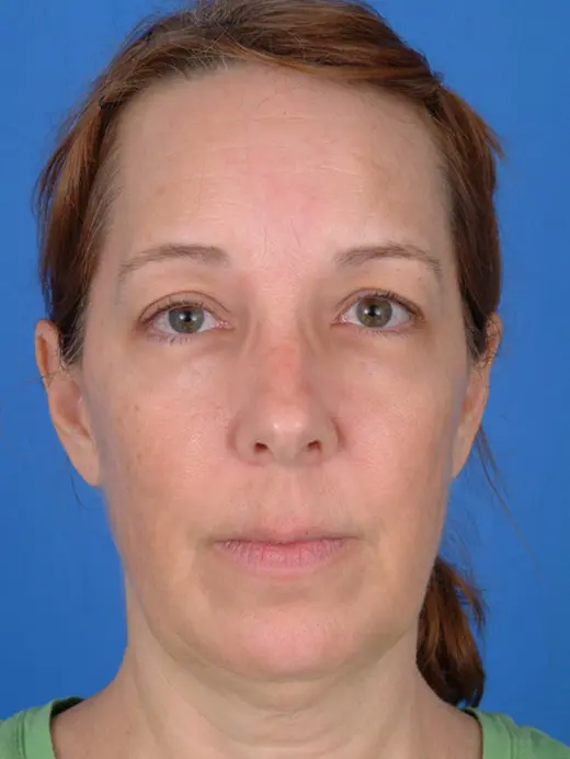 Patient Before & After Photo