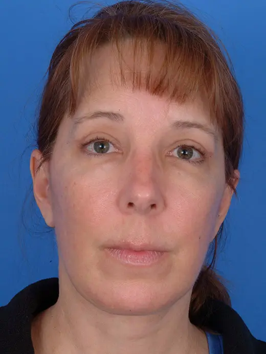 Patient Before & After Photo