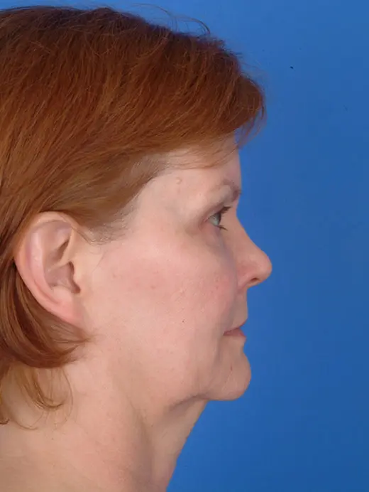 Facelift, Cervicofacial rhytidectomy, MVP Facelift. 7948 profile view pre op