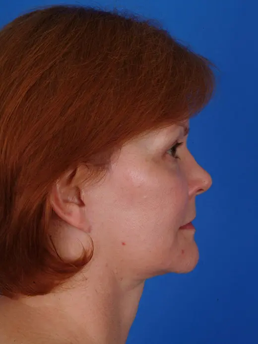 Facelift, Cervicofacial rhytidectomy, MVP Facelift. 7948 profile view post op