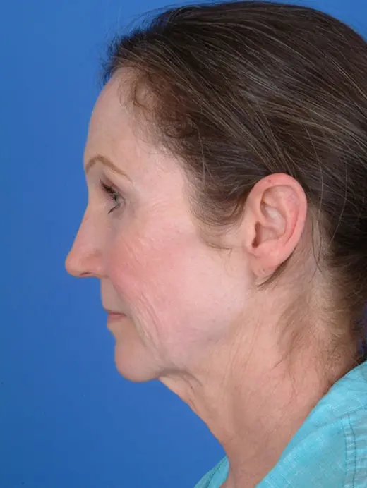 Facelift and Browlift. 7951 profile view pre op