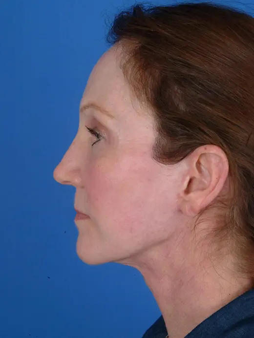Facelift and Browlift. 7951 profile view post op