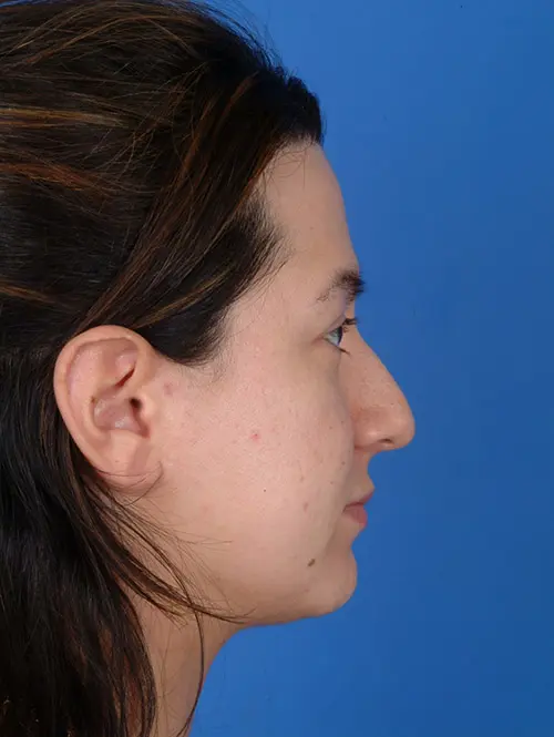 Rhinoplasty with Alar Base Reduction 7956 Profile Before 
