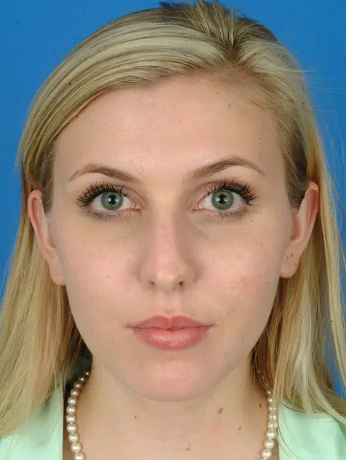 Revision rhinoplasty 7966 Front View Pre Op