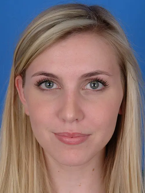 Revision rhinoplasty 7966 Front View 5 Months Post Op