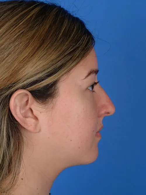 7983 Ethnic Rhinoplasty Profile Before