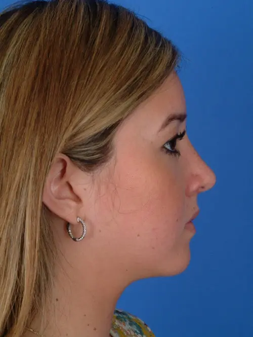 7983 Ethnic Rhinoplasty Profile After