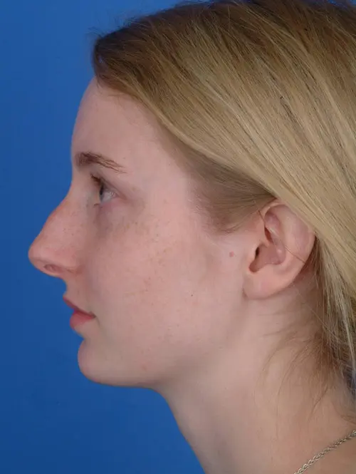 Rhinoplasty 8001 Profile Before