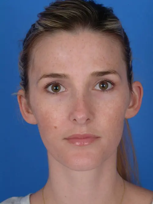 8003 Revision Rhinoplasty Pre Op Front View