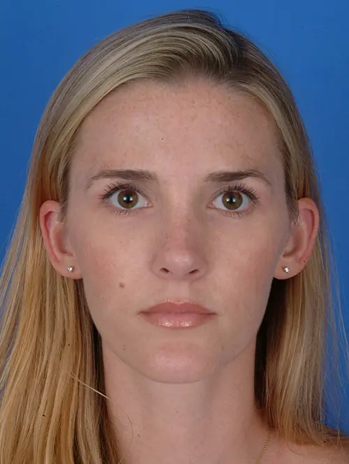 8003 Revision Rhinoplasty  6 months Post Op Front View