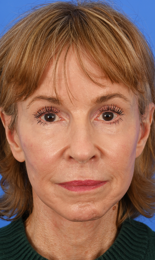 Case--9699 | After Brow Lift