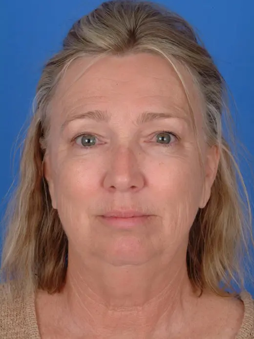 Facelift Chin Augmentation Eyelid Surgery Brow Lift. 9583 front view pre op