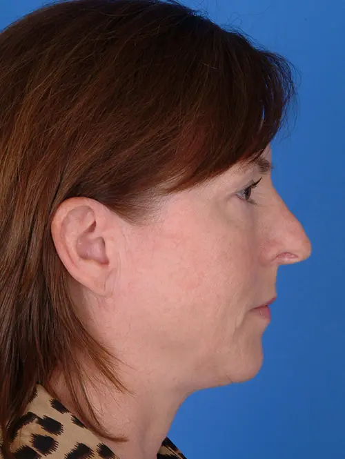 9588 Rhinoplasty Revision Surgery Profile View Pre Op