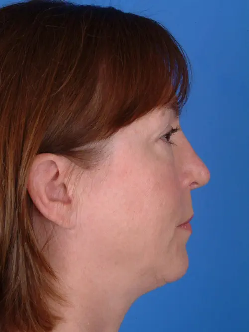 9588 Rhinoplasty Revision Surgery Profile View 7 months Post Op