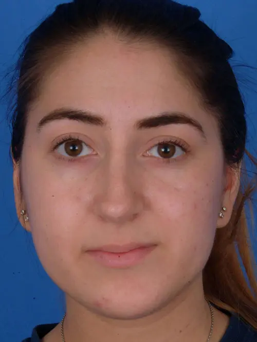 Revision Rhinoplasty with Septoplasty 56751 Pre Op Front View