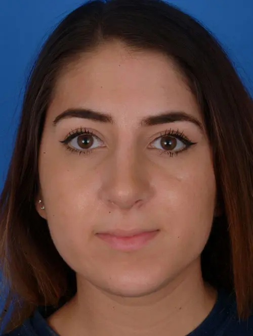 Revision Rhinoplasty with Septoplasty 56751 1 month 6 days post Op Front View