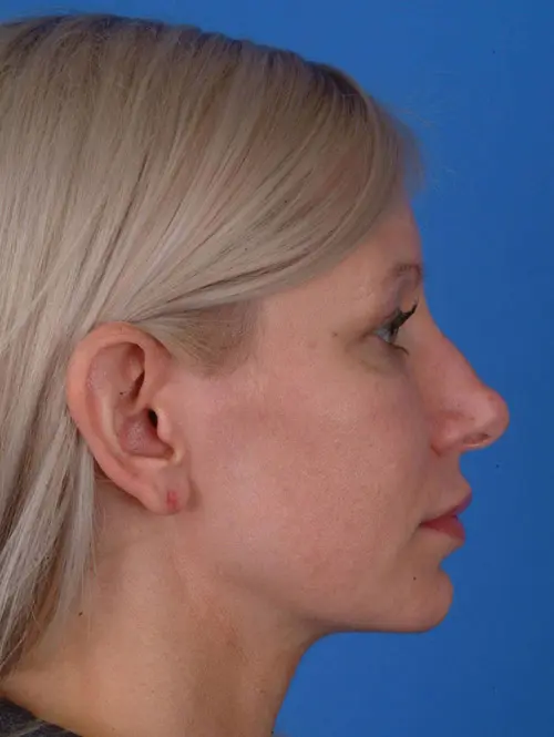 Rhinoplasty 56760 Pre Op Right Profile