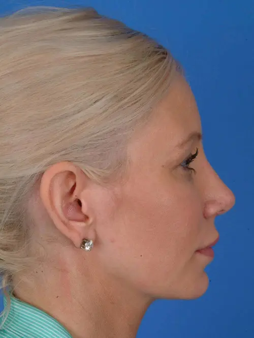 Rhinoplasty 56760 1 Month Post Op Right Profile
