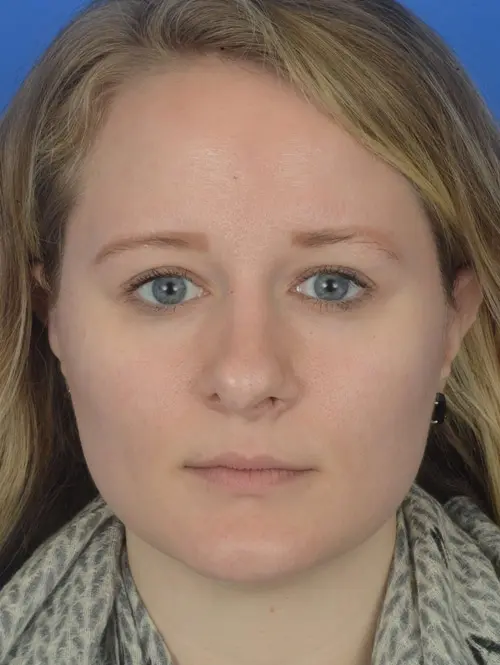 60168 Revision Rhinoplasty Front View Pre Op