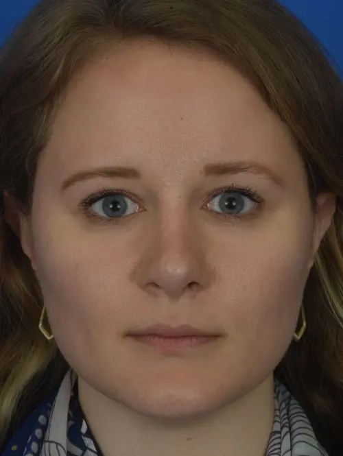 60168 Revision Rhinoplasty Front View 3 moths 26 days Post Op