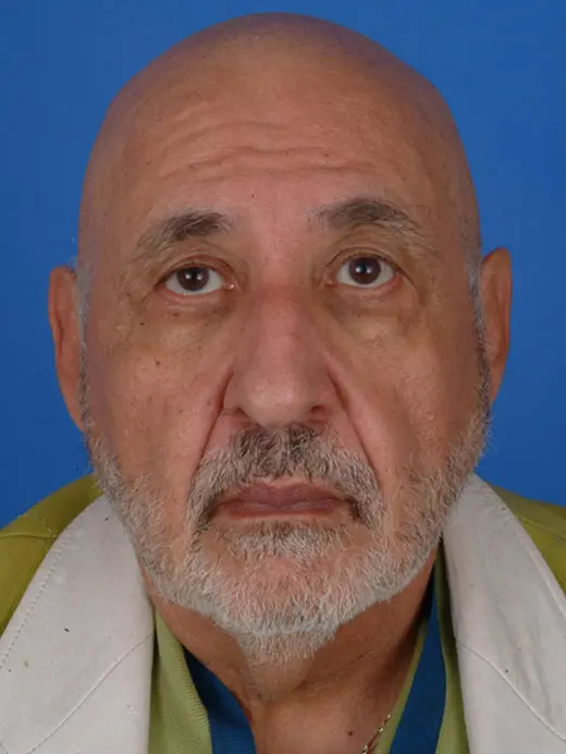 Male Facelift and Eyelid Surgery 60244 Front view pre op